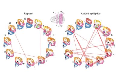 Aplicación pionera de separación de fuentes eléctricas neuronales en humanos para marcar con precisión focos epilépticos y evitar falsos positivos